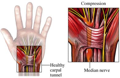 Carpal-Tunnel-Syndrome
