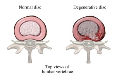 Degenerative-Disc-Disease