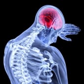 Physical Therapy for Headaches