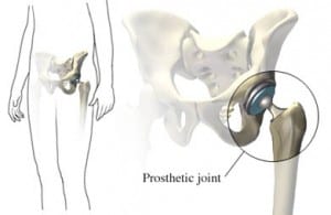 Hip-Replacement-300x195
