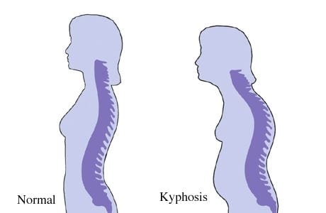 Hyperkyphosis