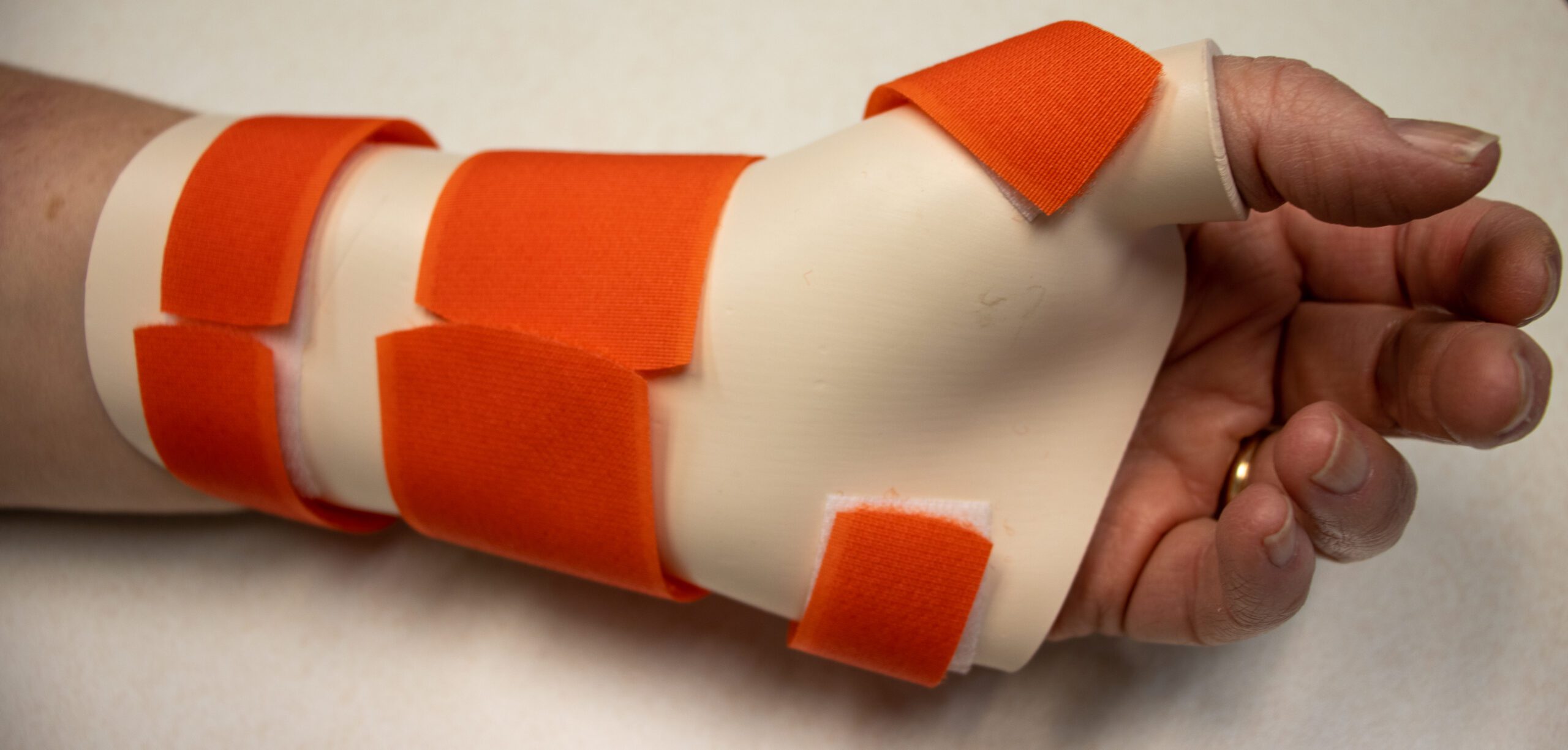 A picture of a patient wearing a hand splint for occupational therapy rehabilitation at STAR Physical Therapy.