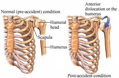Shoulder-Dislocation