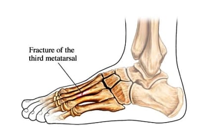 Stress-Fracture-Foot
