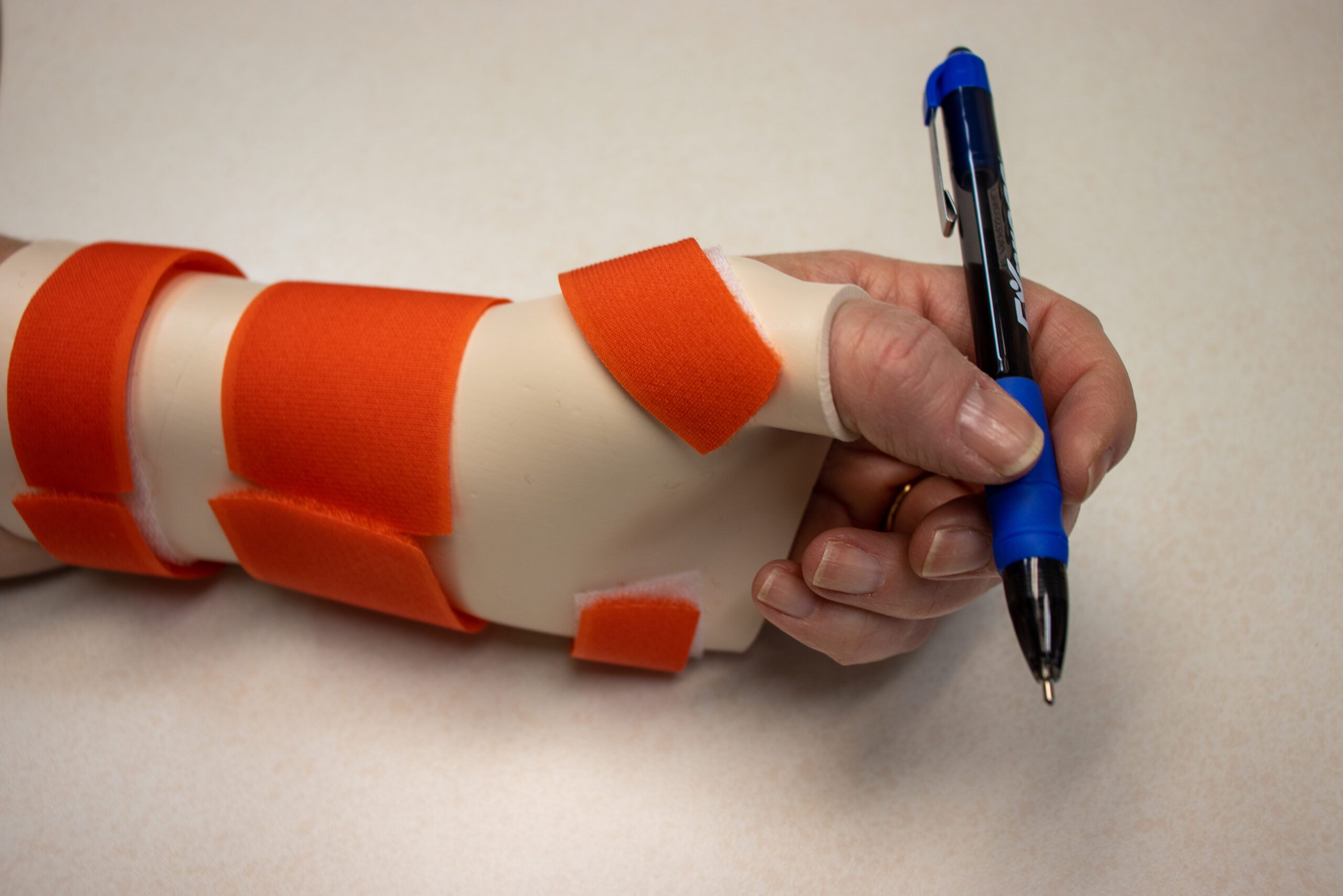 A picture of a patient wearing a hand splint for hand therapy rehabilitation at STAR Physical Therapy.